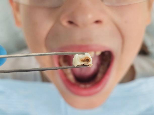 Best Knocked-Out Tooth (Avulsed Tooth) Treatment in Winnsboro, TX